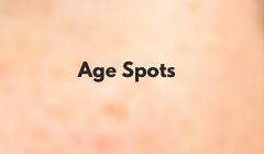 Age Spots