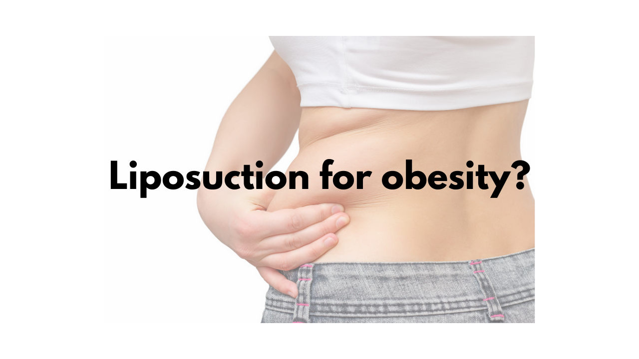 Does liposuction work for obesity?