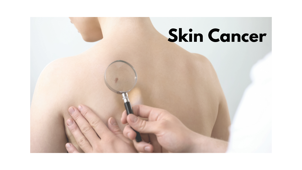 What are the Causes and Risk Factors of Skin Cancer?