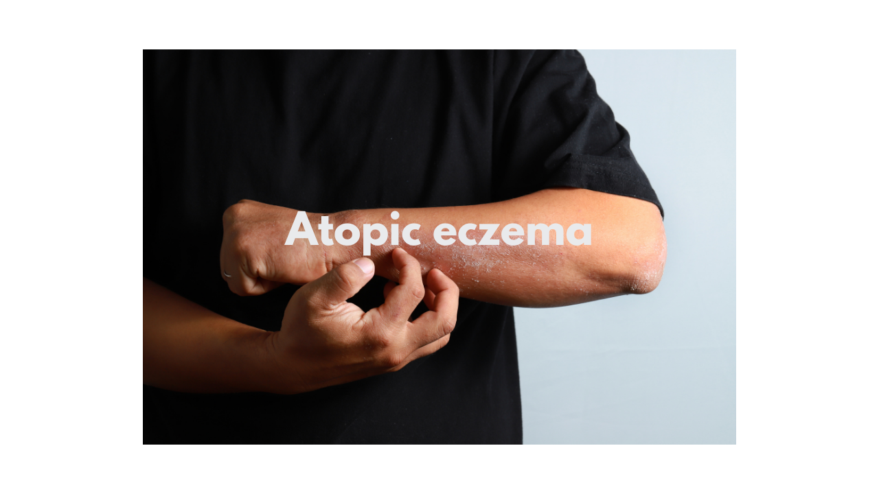 What is Atopic eczema