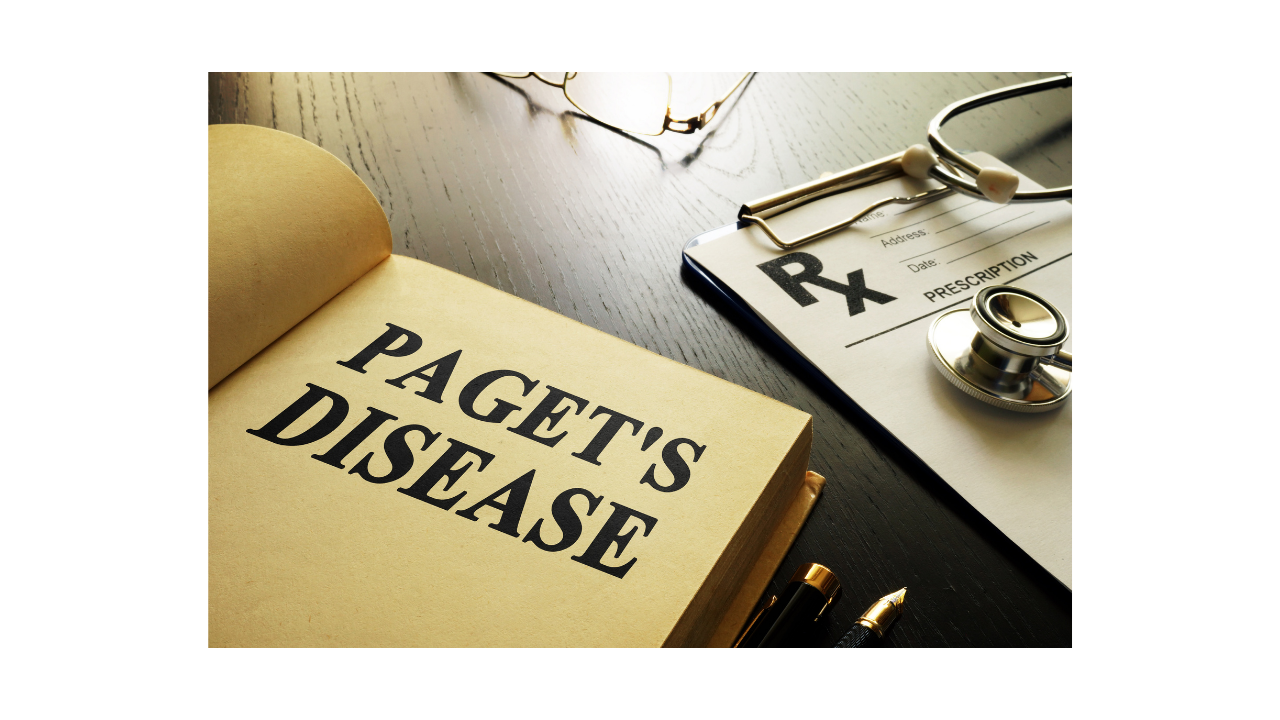 What is Paget's Disease of Bone ?