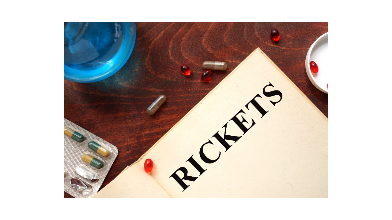 What is Rickets?