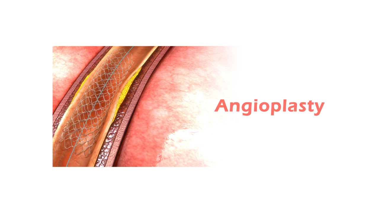 What is angioplasty?